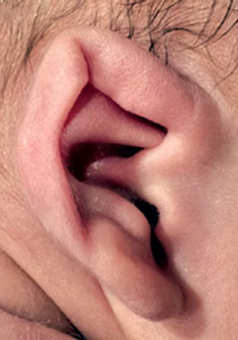 Smíšené deformity