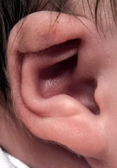 Převislý boltec - EarWell