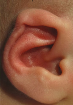 Helikální deformity - EarWell